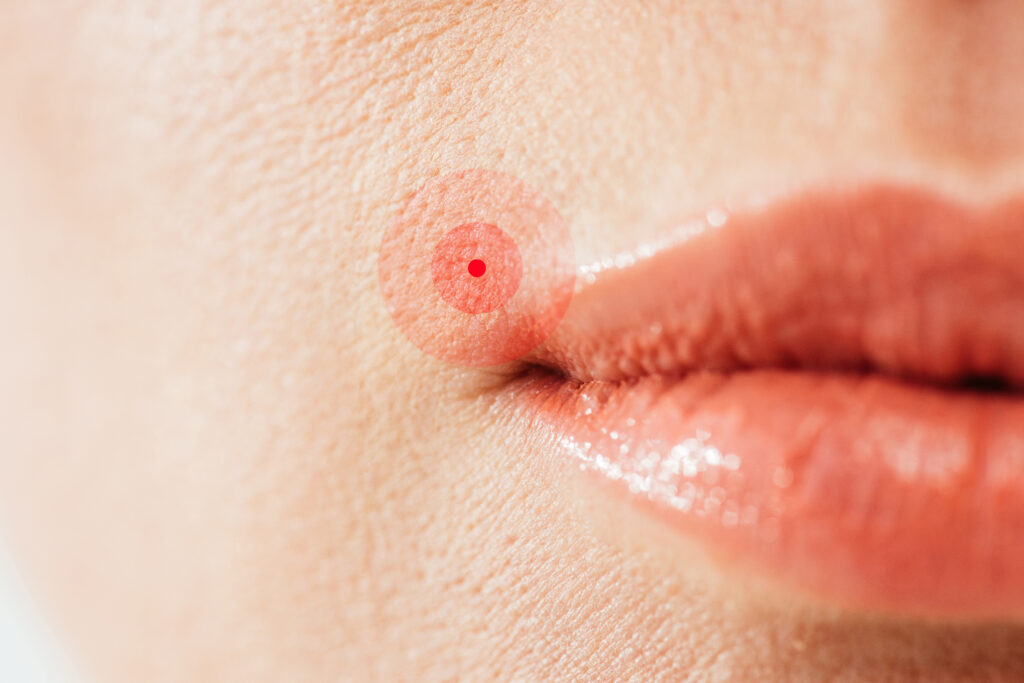 a meth sore above a woman's lip