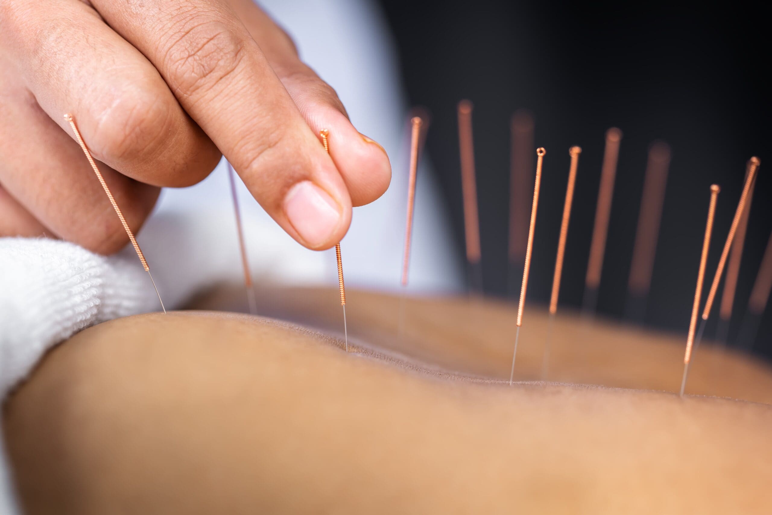 individual receiving acupuncture in a wellness therapy session